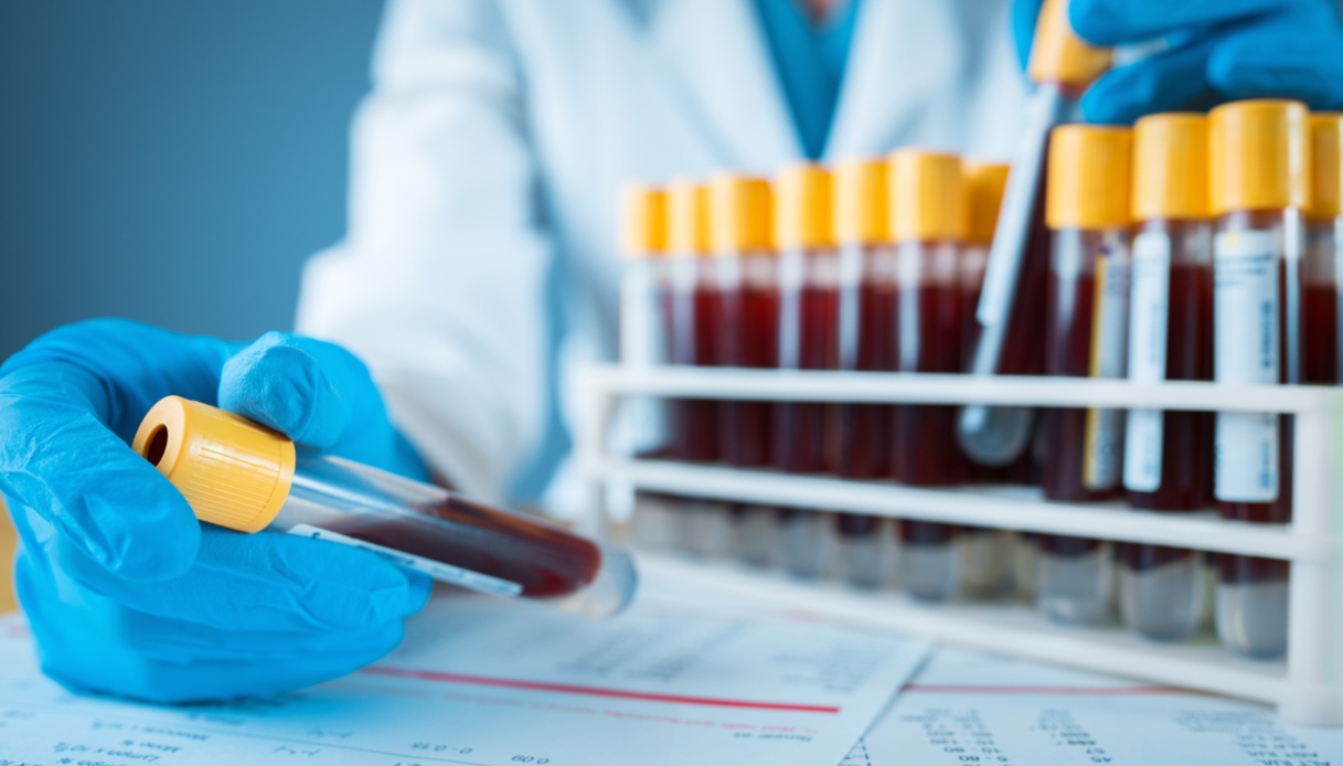 Epidemia da shigellosi: cos’è e sintomi della malattia