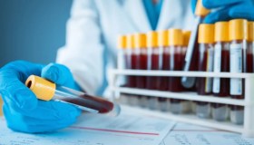 Hiv in Usa dopo il “lifting del vampiro”: il trattamento Prp anche in Italia