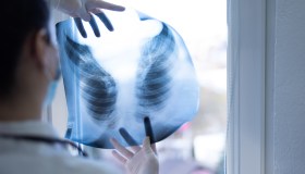 Tumore del polmone, quanto è importante lo screening e come può cambiare la prognosi