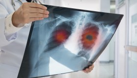 Tumori in aumento, anche tra i giovani: quanto costa curarsi in Italia